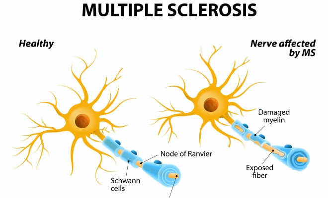 Multiple Sclerosis (MS)